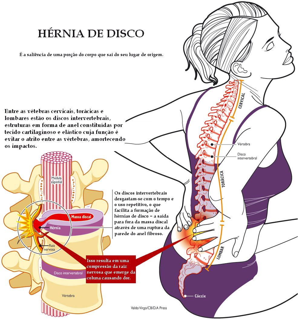 El método del tratamiento de la hernia intervertebral gerasimova